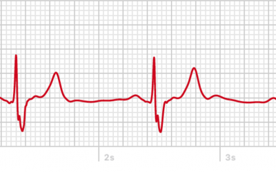 EKG mit der Apple Watch