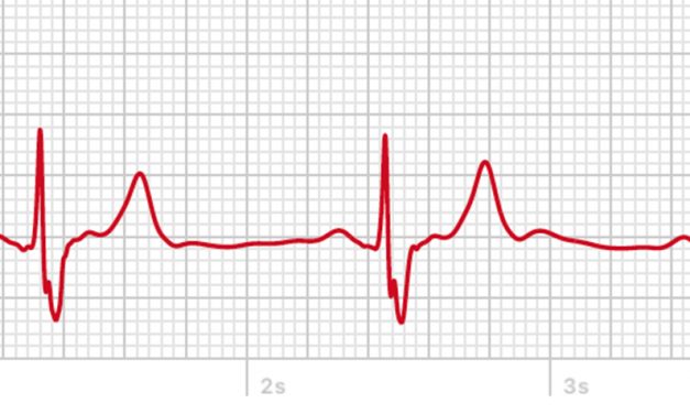 EKG mit der Apple Watch